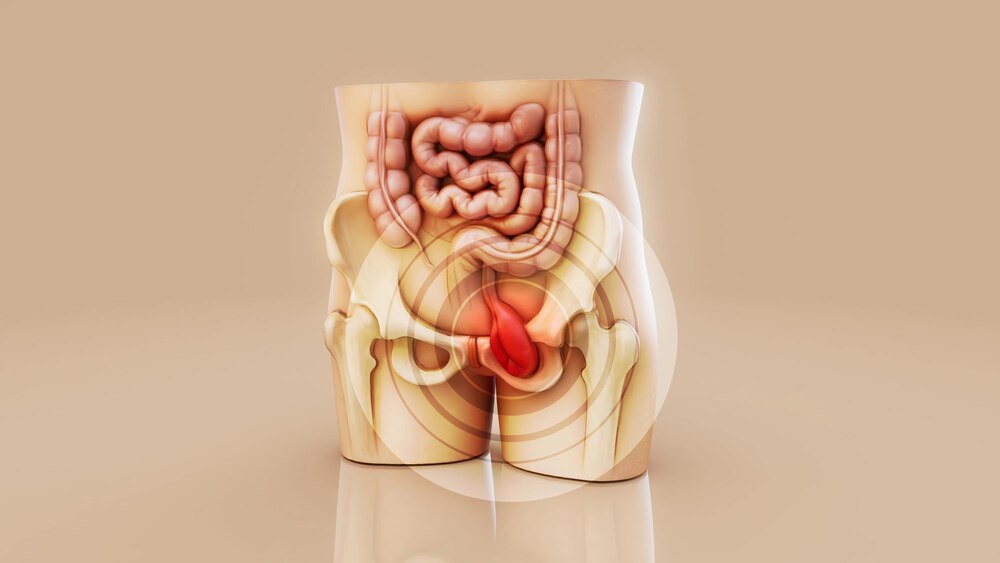 Conceptual 3D illustration of a human hernia